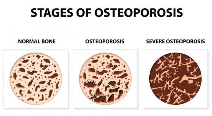 Phenols in EVOO May Protect Bone Mass